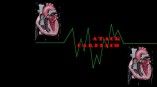 Atack Cardiaco
